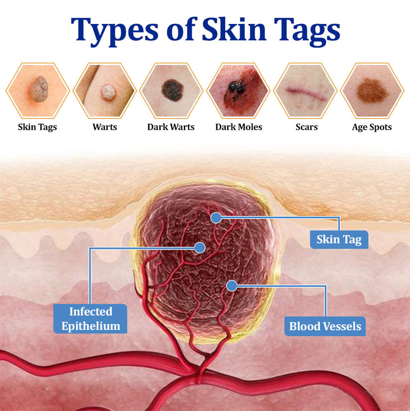 👩‍⚕️LOVILDS™ BeeDerm RX Cream, Painless, easy and gentle fix for warts, skin tags, lumps, infections, cysts and scars🎁