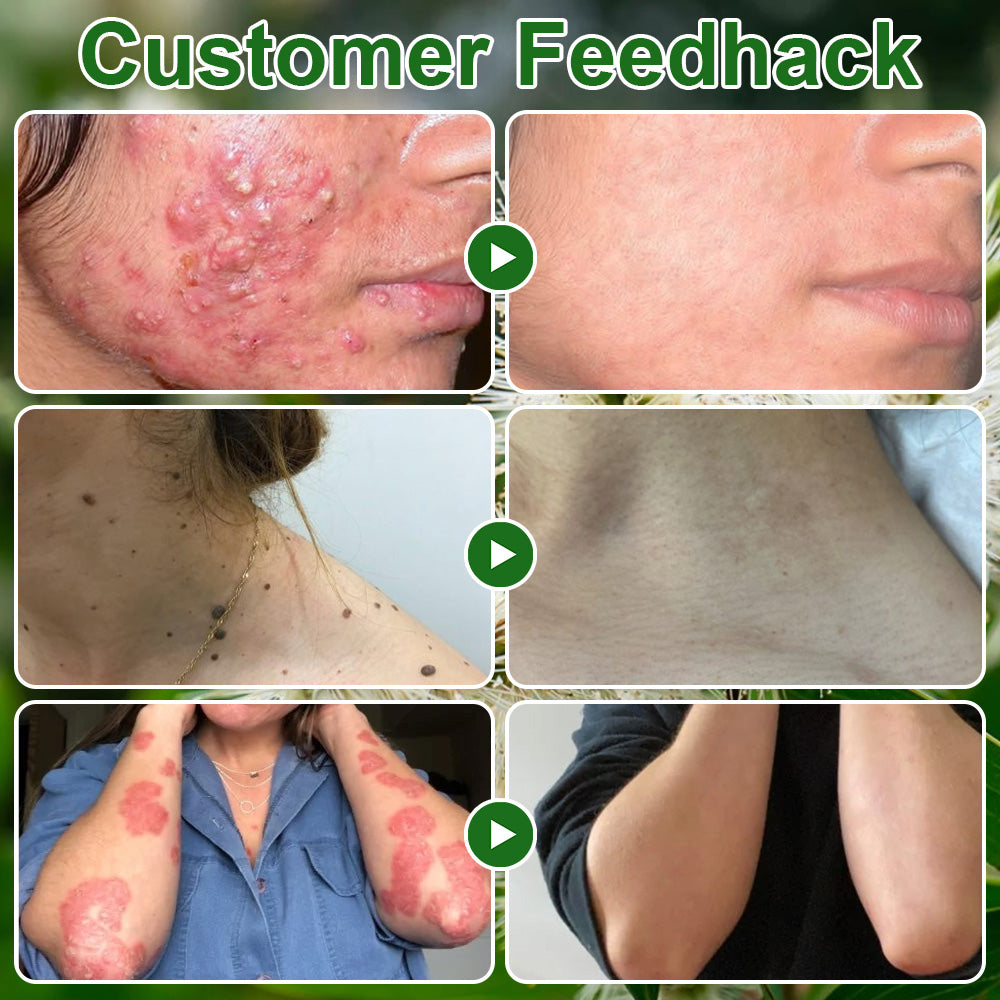 🔥BBOJI  Tea Tree Oil Skin Treatment Cream✅𝐅𝐃𝐀-𝐀𝐏𝐏𝐑𝐎𝐕𝐄𝐃 – Removes Skin Blemishes, Repairs Damaged Skin, Brightens & Anti-Ageing Care