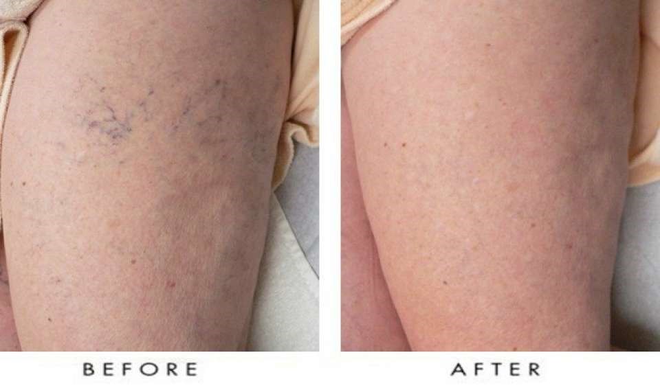 Glowrizon® LegRenew Varicose Veins Patch