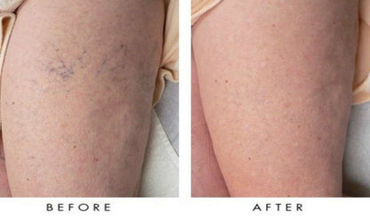 Glowrizon® LegRenew Varicose Veins Patch