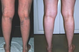 Glowrizon® LegRenew Varicose Veins Patch