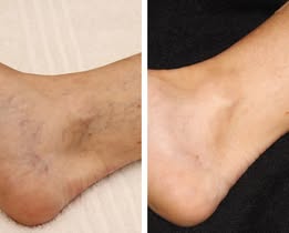 Glowrizon® LegRenew Varicose Veins Patch