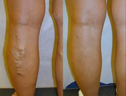 Glowrizon® LegRenew Varicose Veins Patch