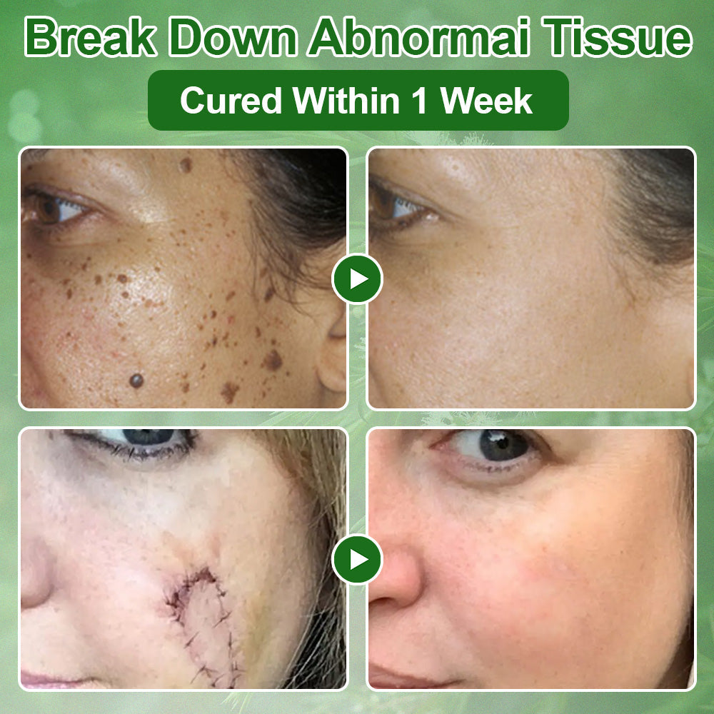 🔥BBOJI  Tea Tree Oil Skin Treatment Cream✅𝐅𝐃𝐀-𝐀𝐏𝐏𝐑𝐎𝐕𝐄𝐃 – Removes Skin Blemishes, Repairs Damaged Skin, Brightens & Anti-Ageing Care