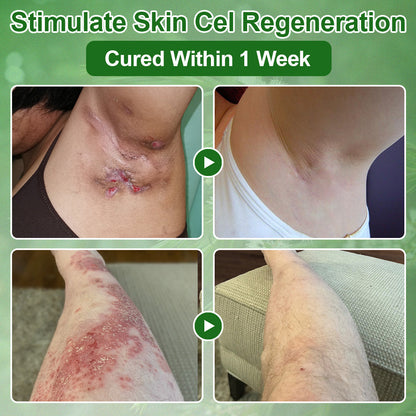 🔥BBOJI  Tea Tree Oil Skin Treatment Cream✅𝐅𝐃𝐀-𝐀𝐏𝐏𝐑𝐎𝐕𝐄𝐃 – Removes Skin Blemishes, Repairs Damaged Skin, Brightens & Anti-Ageing Care